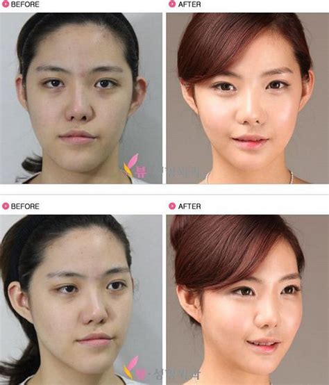 lv plastic surgery korea.